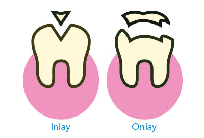 differences between inlays and Onlays