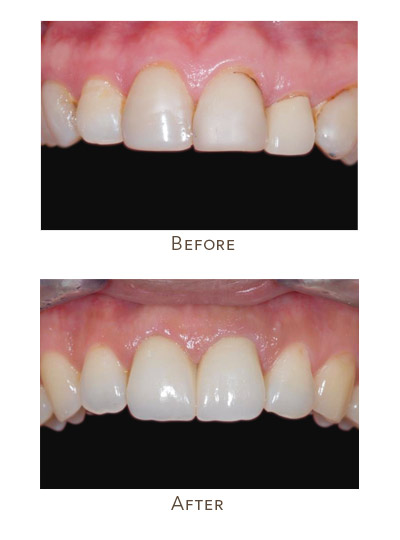dark lines on teeth near gums