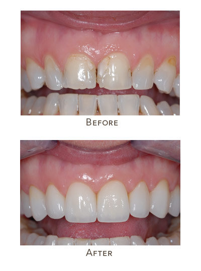fix uneven teeth surface in just one day