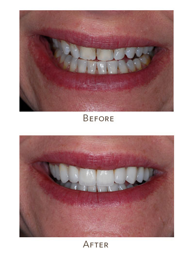 Whiter and straighter Teeth in a day