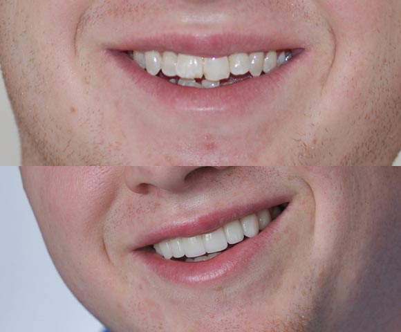 fix overlapping front teeth