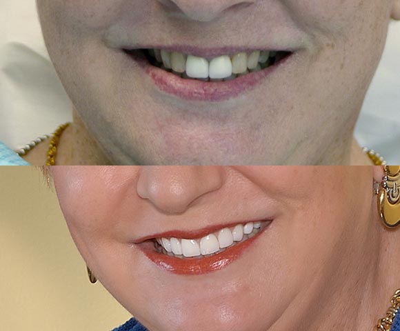 uneven teeth color treatment