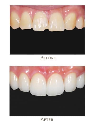 Before & After Image of Veneers West Houston TX