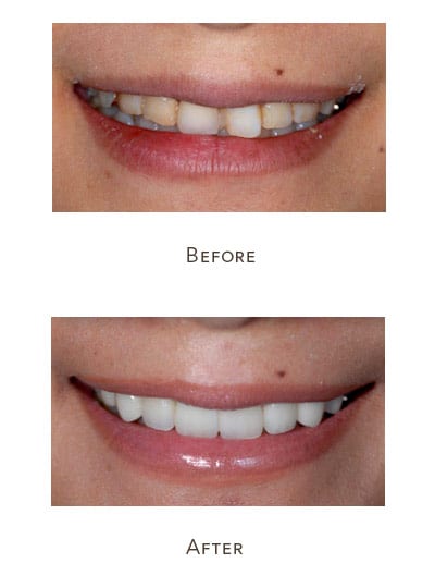 Before & After Image of Dental Veneers West Houston TX