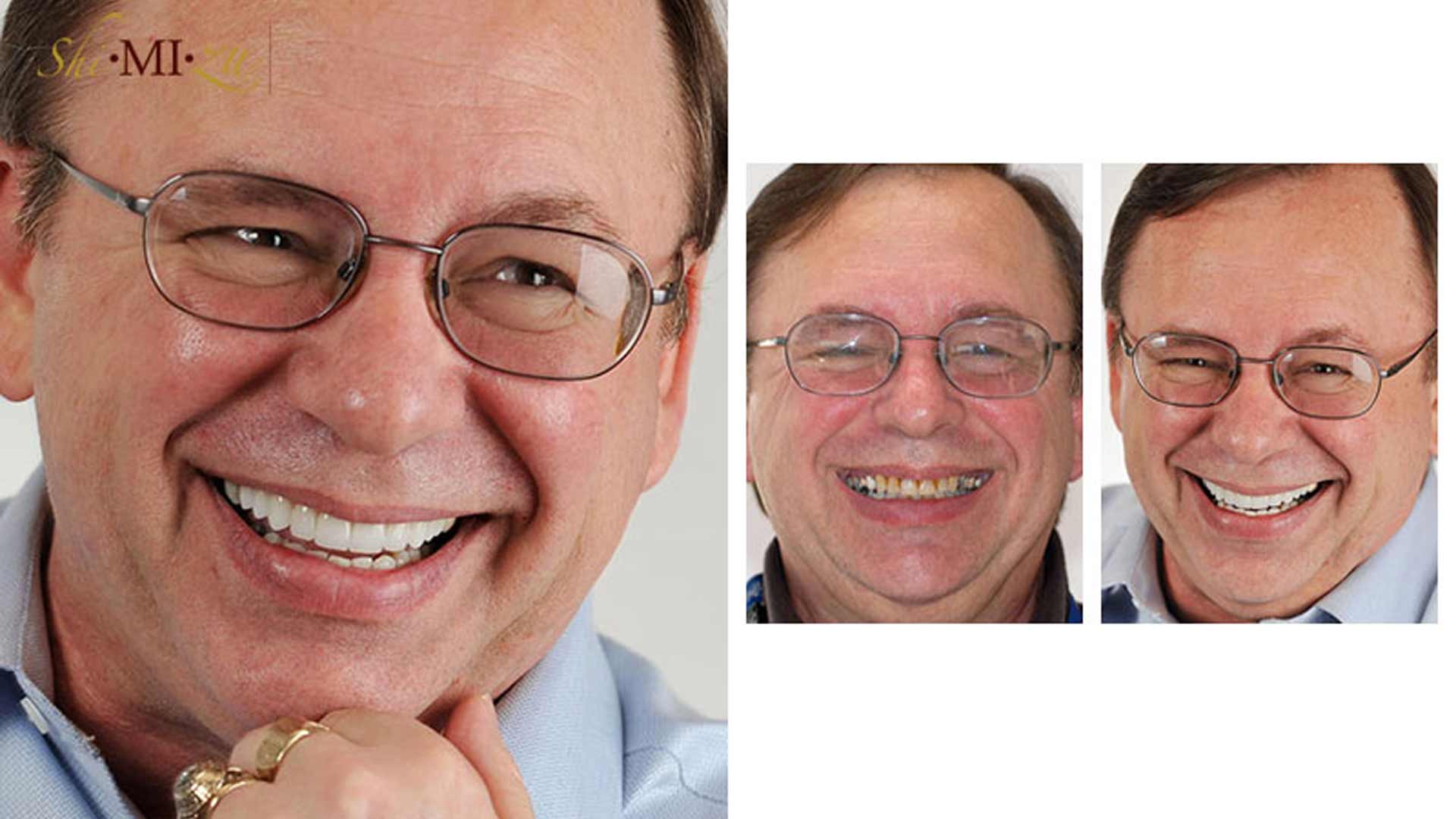 worn out uneven teeth fix