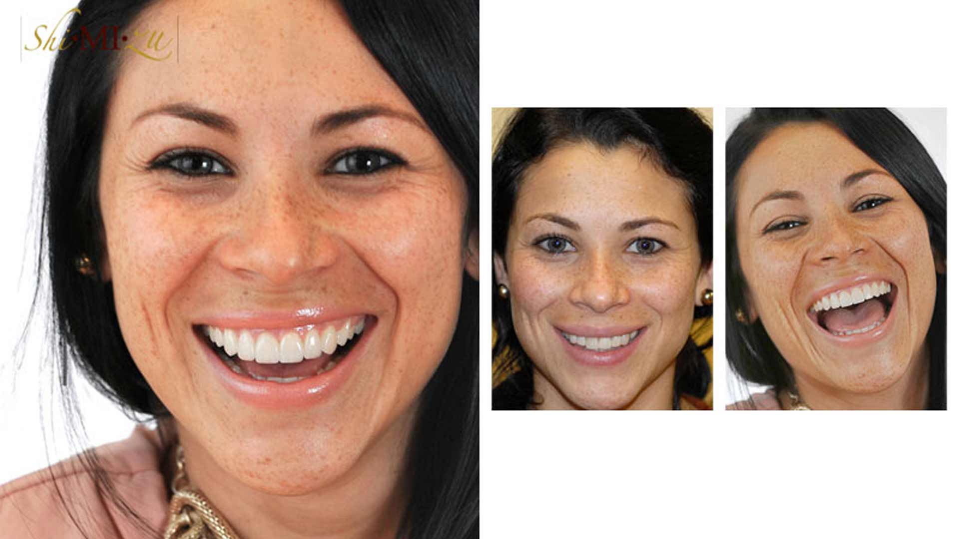 fix chipped veneers