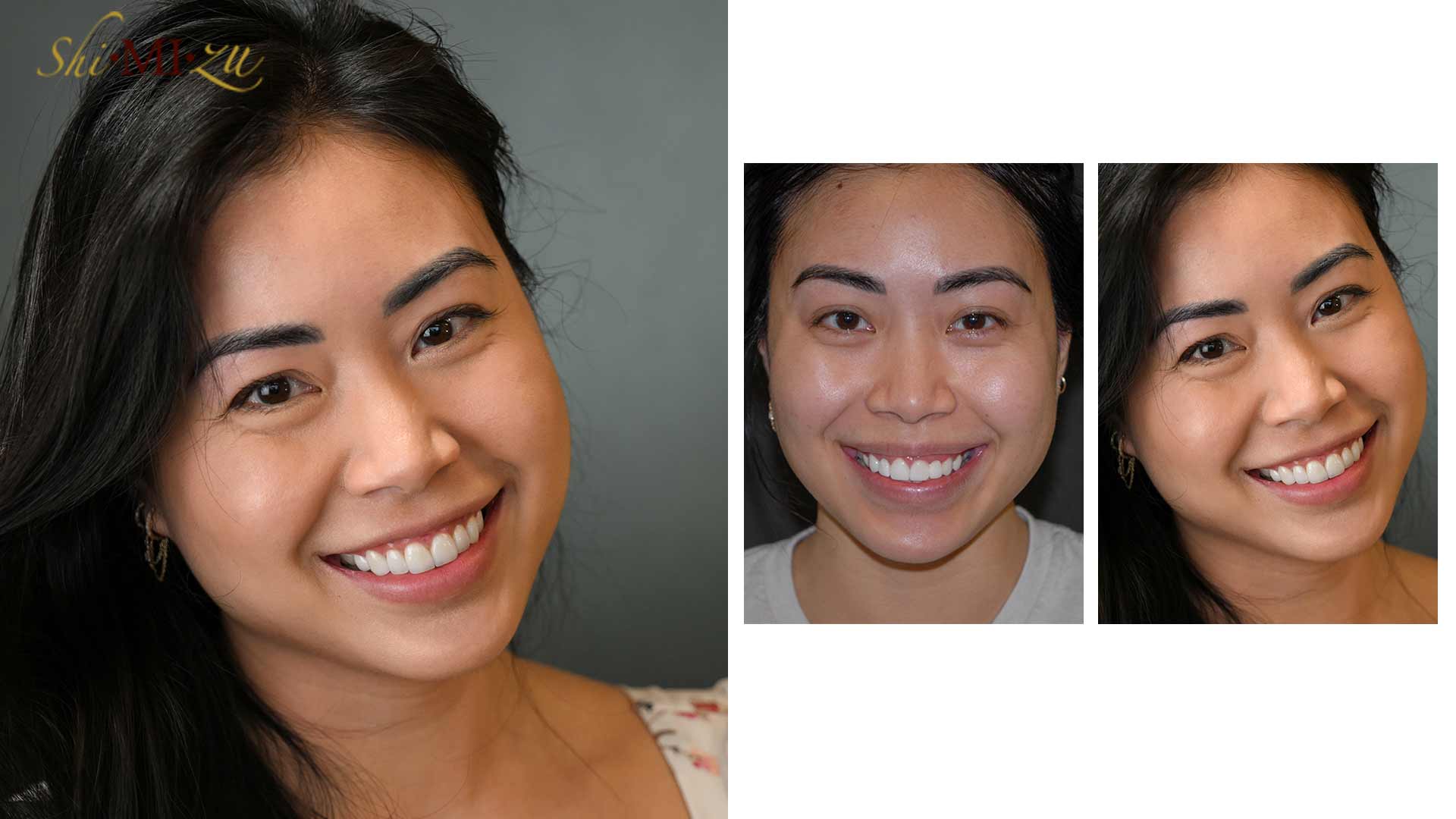 replacing lumineers veneers before after