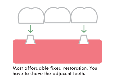 dental bridge is affordable