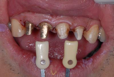 gold dental post