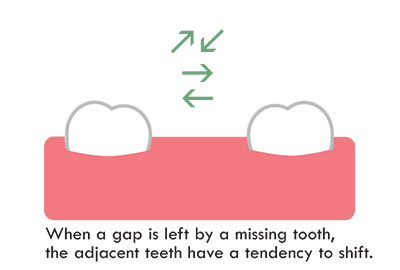 missing tooth cause other teeth to shift