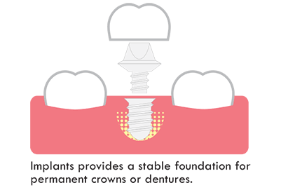 implant is the most durable