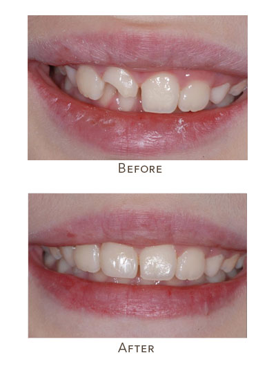 fix child's broken front tooth