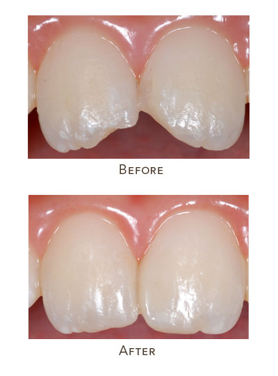 fix fractured upper front teeth