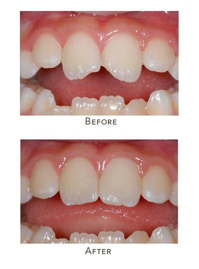kid's fractured central teeth