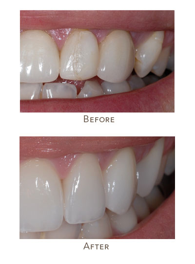 fix cracked veneers