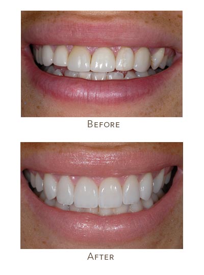 cracked veneers before after