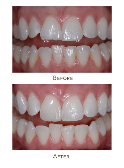 dental bonding before after