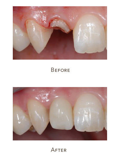 tooth implant before after