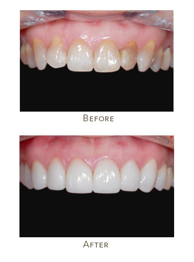 deep dental discoloration cannot be treated through teeth whitening