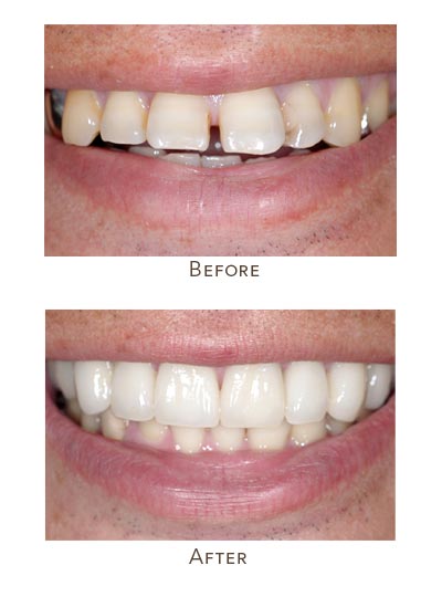 fix flared teeth