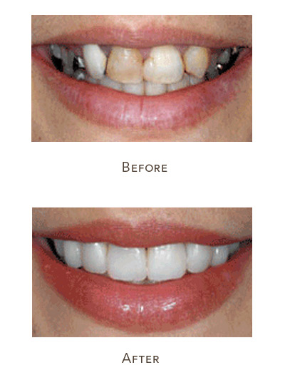 Veneers are a great solution for correcting bad teeth