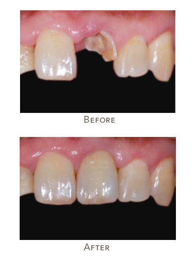 fron upper tooth color matching to existing teeth