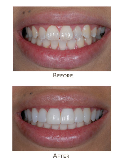 no prep veneers upper teeth before after