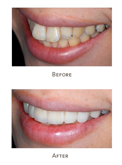 buck teeth before and after braces