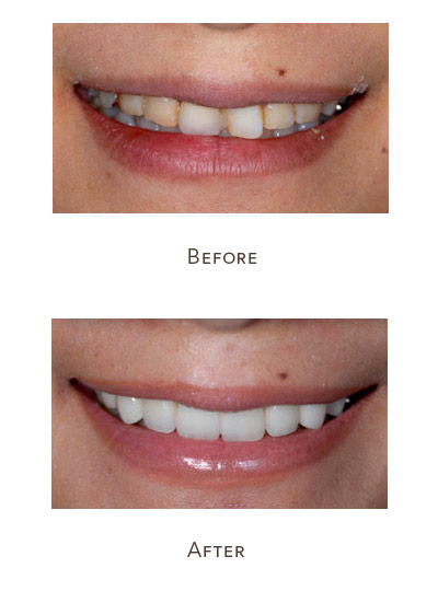 veneers before and after crooked teeth