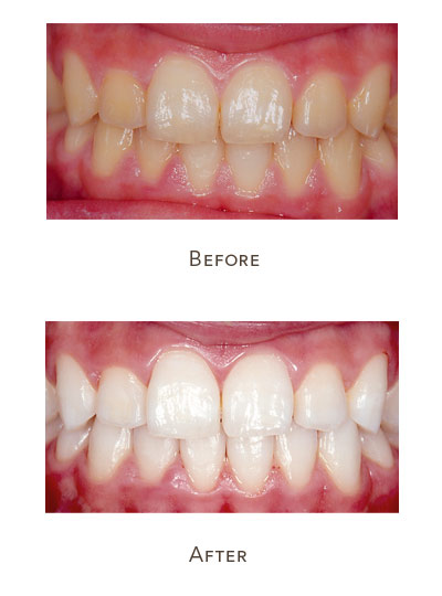 teeth whitening before and after