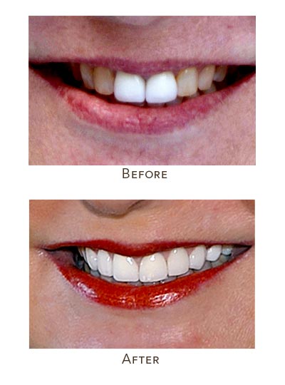 cracked veneers before after