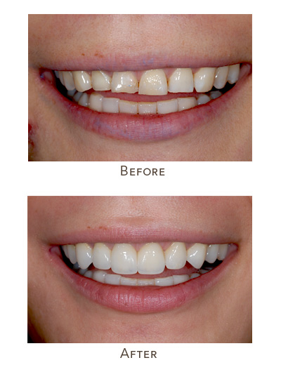 worn upper front teeth length changes