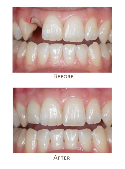 fron upper tooth color matching to existing teeth