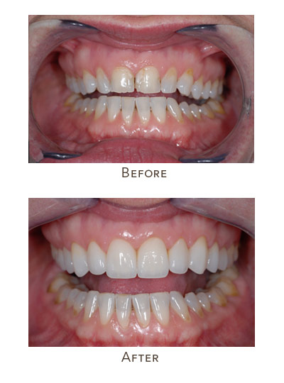 Same day smile makeover