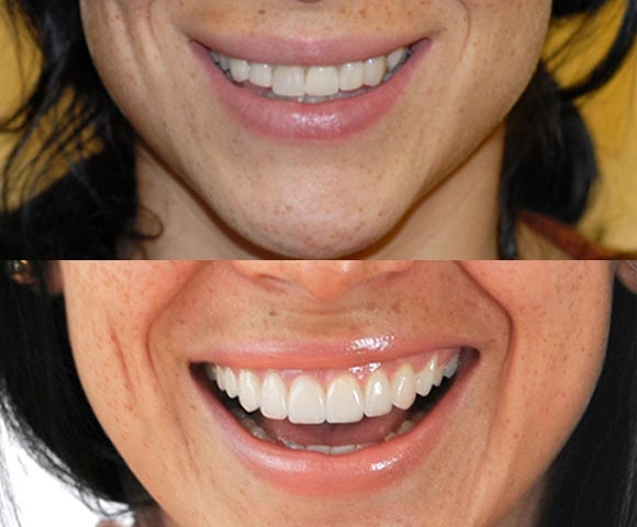 Chipped dental veneers