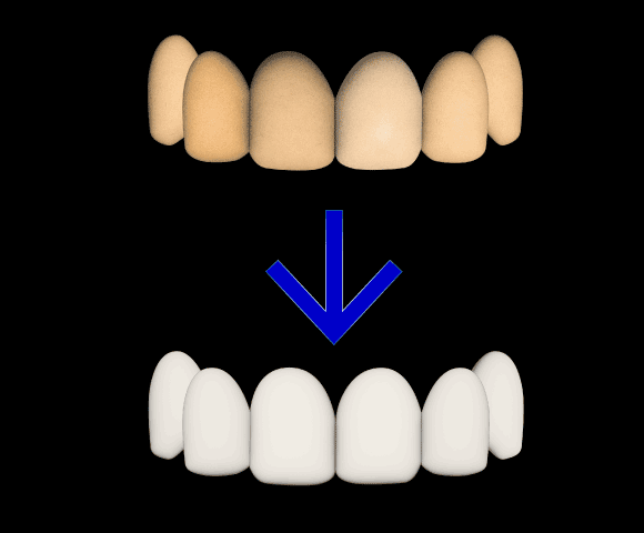 fix discolored teeth