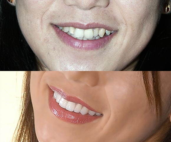 fix crooked teeth without braces