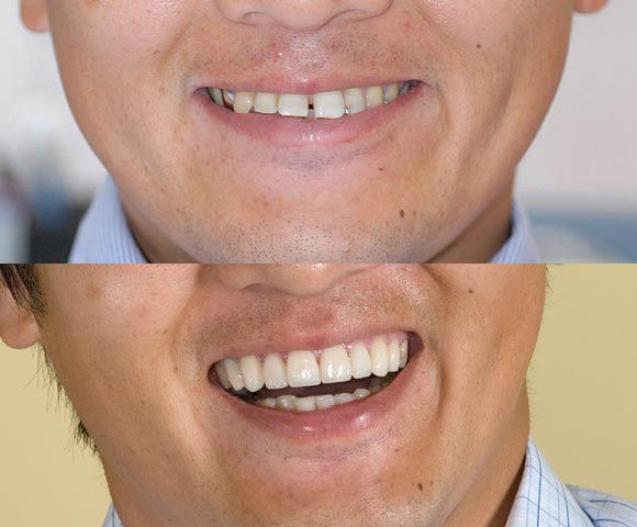 flared teeth fix