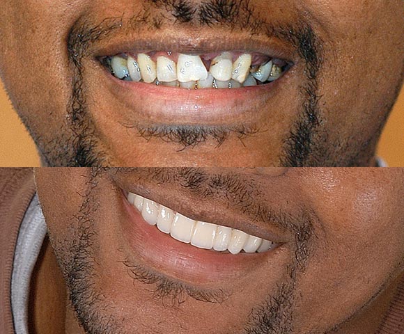 fix missing teeth