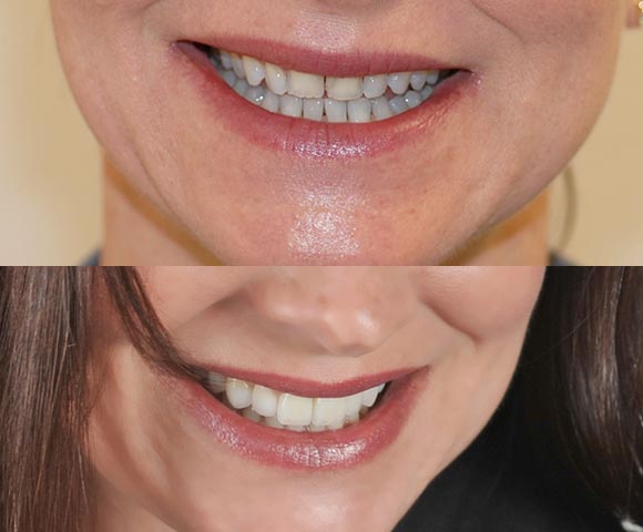 Veneers small teeth fix before after