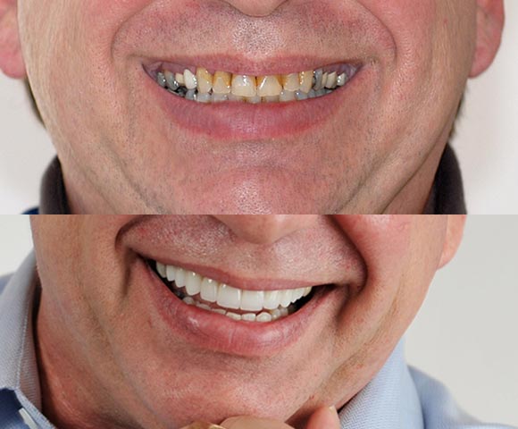 fix short teeth