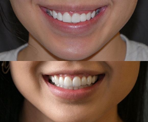 replacing lumineers veneers