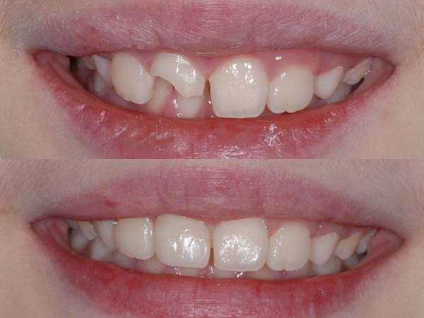 child's broken permanent front upper tooth before and after
