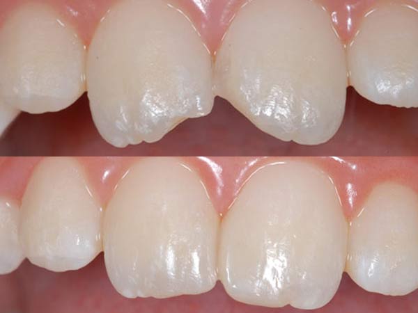 child's broken front teeth fixed with layered bonding over the teeth