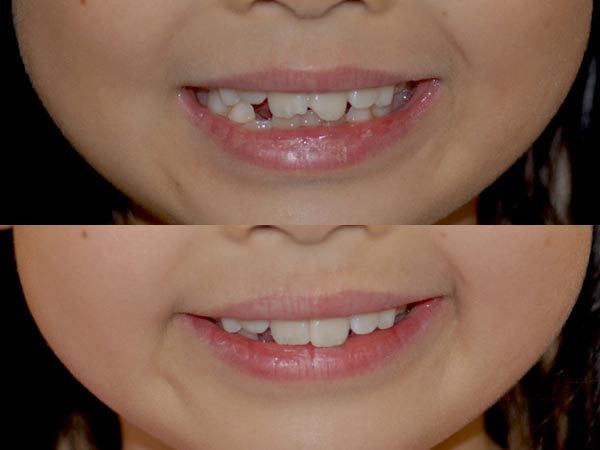 veneers applied to child's teeth