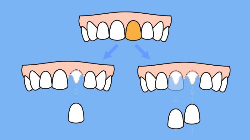 Do you need to replace adjacent teeth if you need one crown or veneer on your upper central tooth due to carries, discoloration, or chipping of the crown?