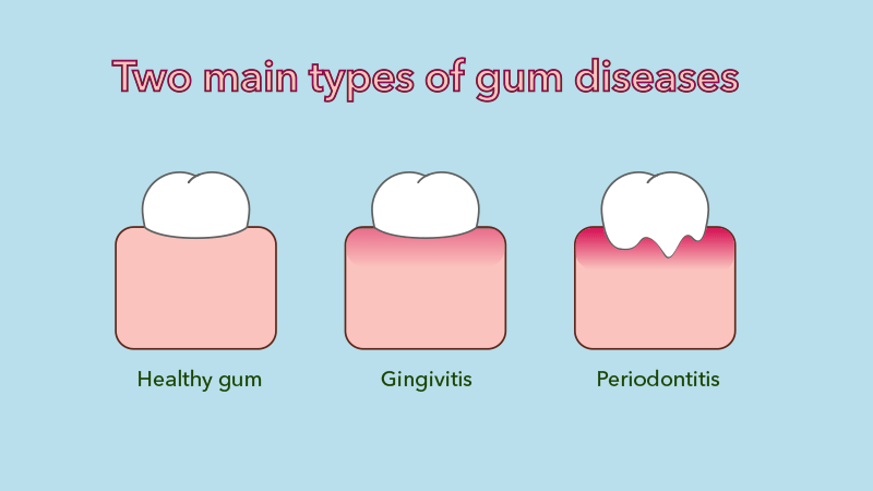 types of gum diseases