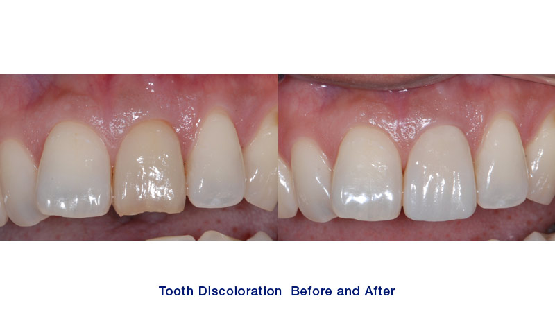 One upper central tooth on your right side has discoloration, and it is also chipped at the tip of the crown after root canal treatment. This tooth was crowned in our office.