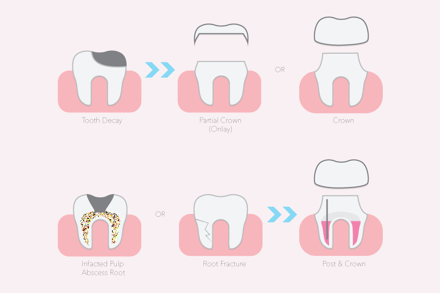 crown or filling depends on your conditions