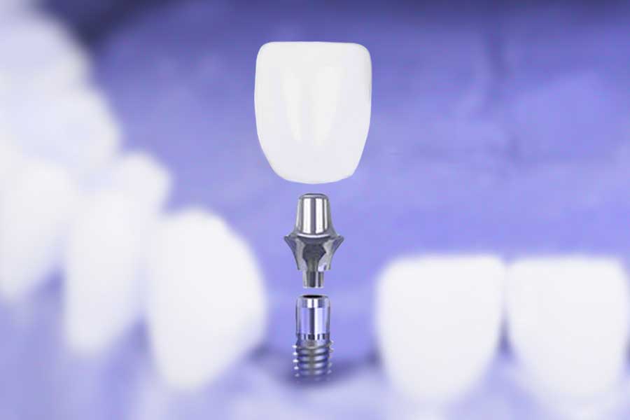dental implant tooth